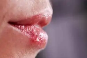 herpes simplex virus mouth ulcers va