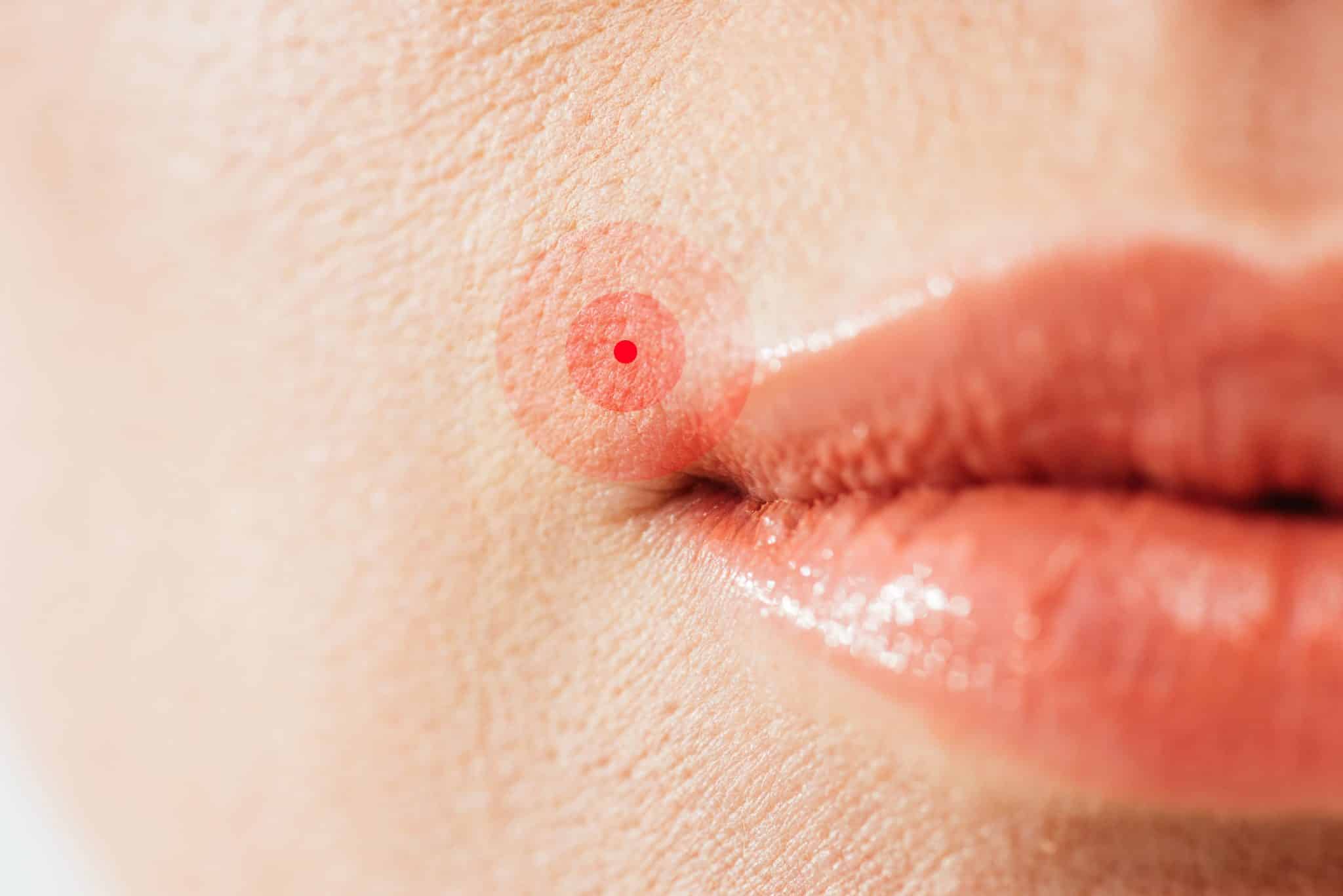 PTSD and Herpes Simplex Virus