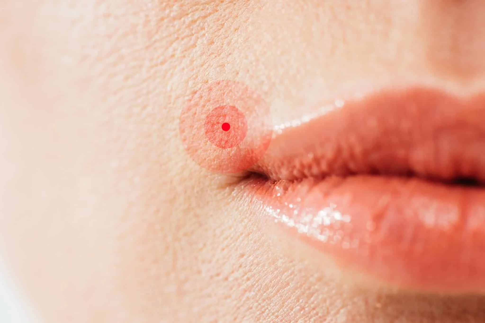 PTSD and Herpes Simplex Virus