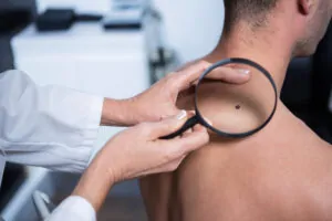 Melanoma and Veterans Disability