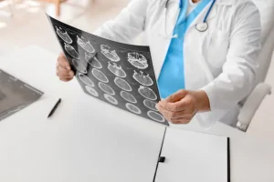 traumatic brain injury TBI VA rating