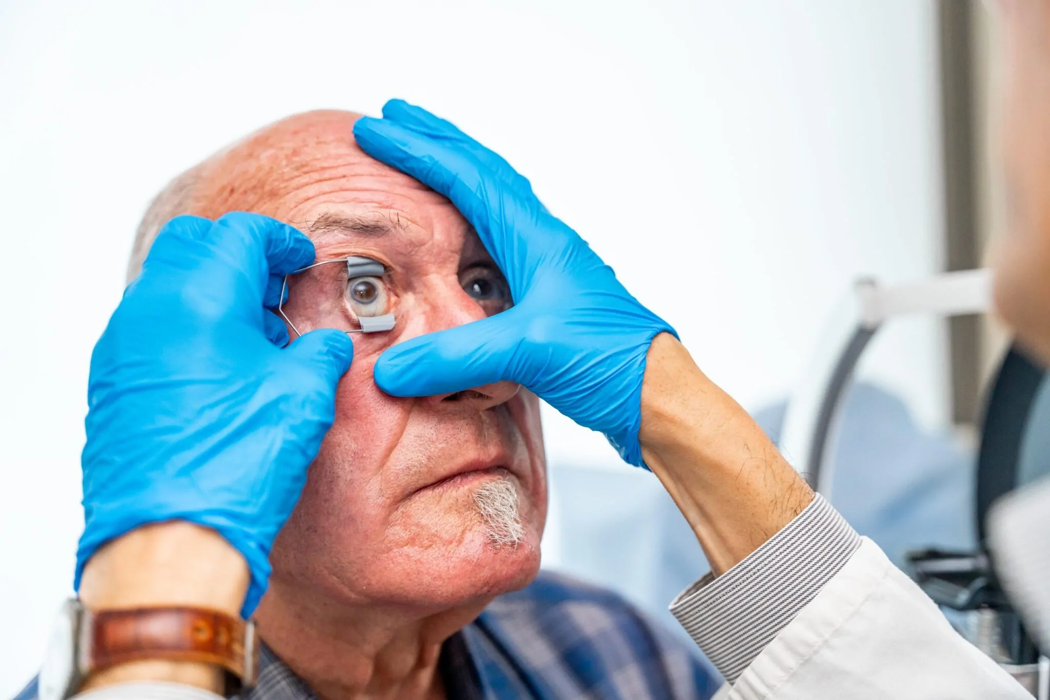 Cataracts and VA Disability