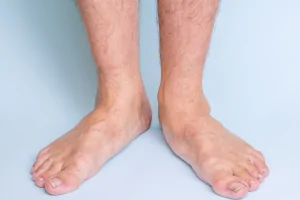 Flat Feet VA Rating